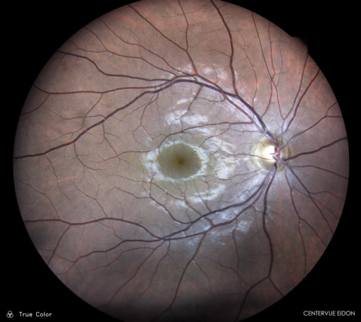 Cámara Retinal No Midriática Eidon FA - Imagen 4